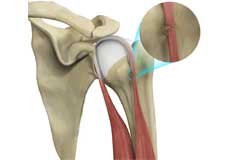 Proximal Biceps Tendon Rupture1