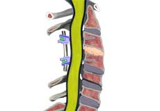 Pseudarthrosis/Nonunion