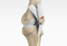 quadriceps-tendon-rupture