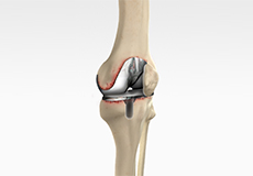 revision-kneereplacement