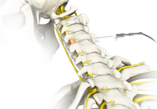 Spinal Facet Rhizotomy