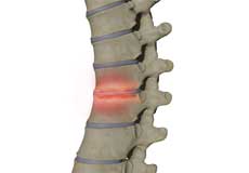 Spondylodiscitis