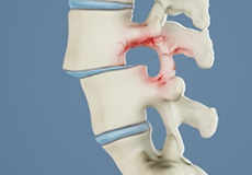 Spondylolisthesis