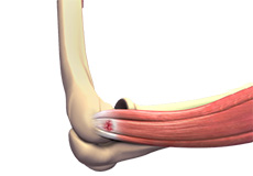 tennis-elbow