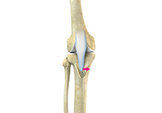 tibial-tubercle-osteotomy