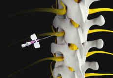 Transforaminal Epidural Steroid Injection