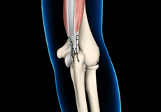 triceps-tendon-repair